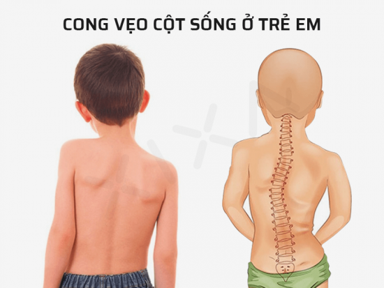 Vẹo cột sống ở trẻ nguyên nhân, biểu hiện và các biện pháp phòng ngừa