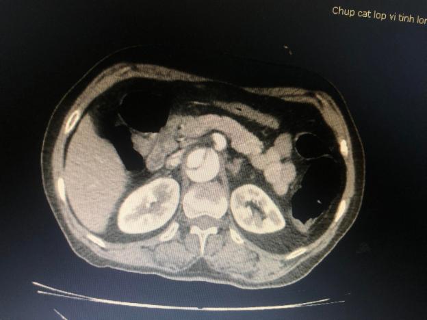 Hình ảnh phình tách động mạch chủ trên phim chụp cắt lớp vi tính lồng ngực của người bệnh. (ảnh BVCC)