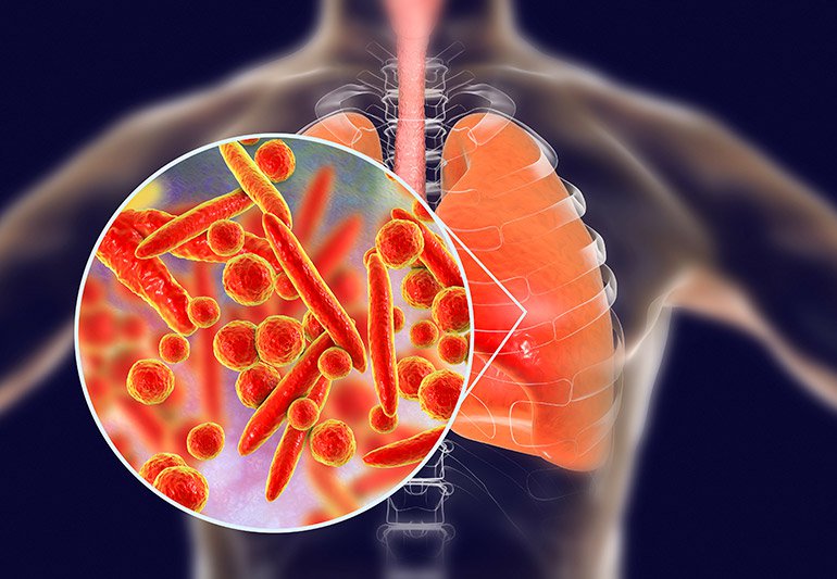 Phân biệt viêm phổi thông thường và viêm phổi do Mycoplasma