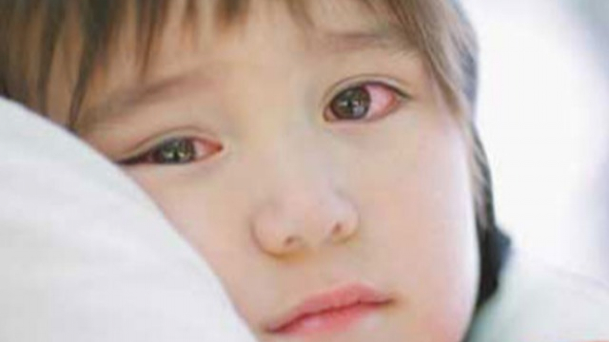 Nhiều trẻ gặp biến chứng nặng do đau mắt đỏ, chuyên gia khuyến cáo gì?